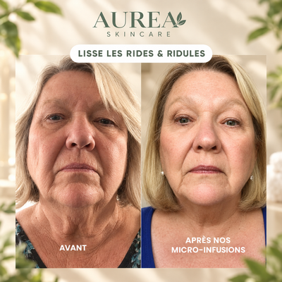 Micro-Infusion Anti-Âge