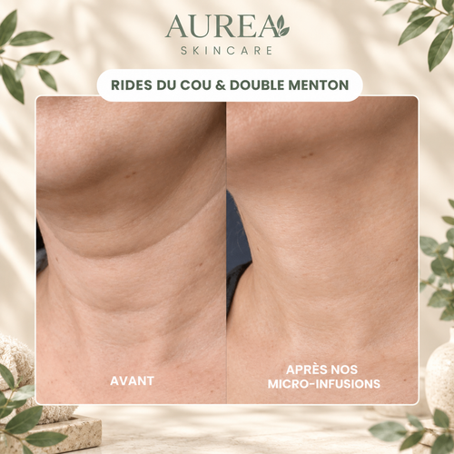 Micro-Infusion Anti-Âge