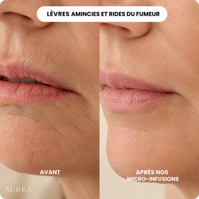 Micro-Infusion Anti-Âge